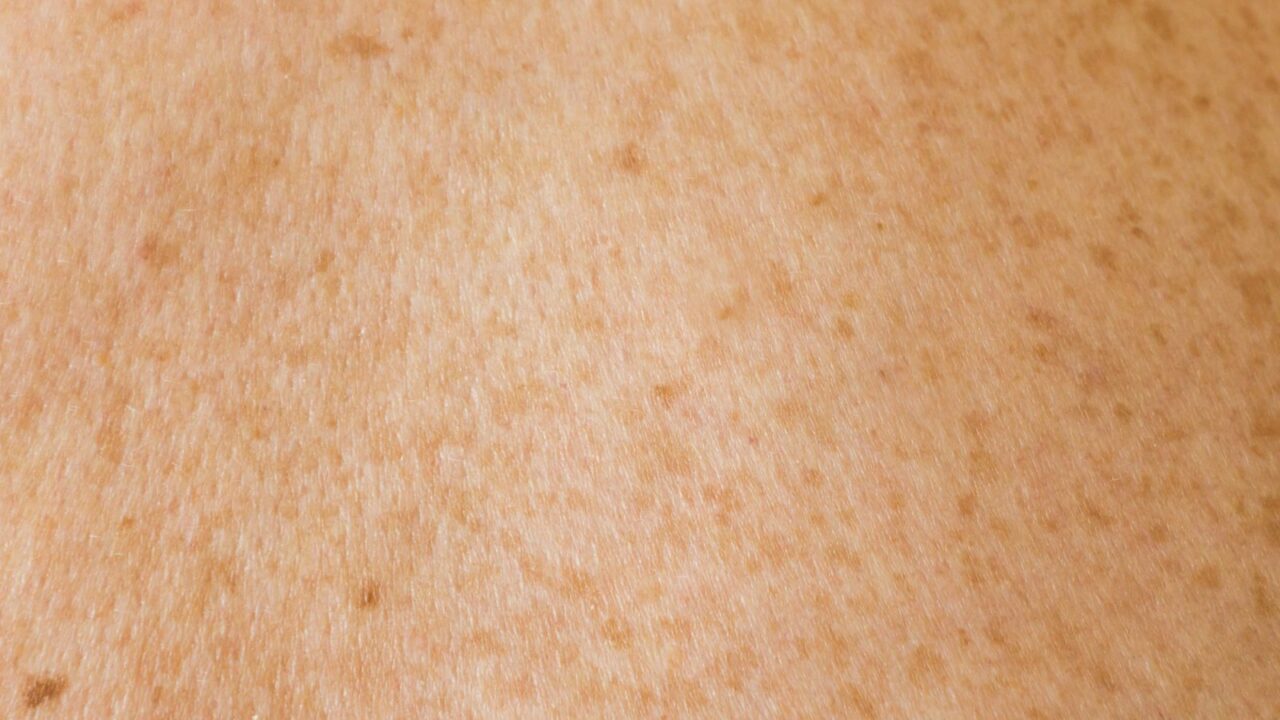 Kodėl soliariumo įdegis nėra saugus, net jei oda neparausta?